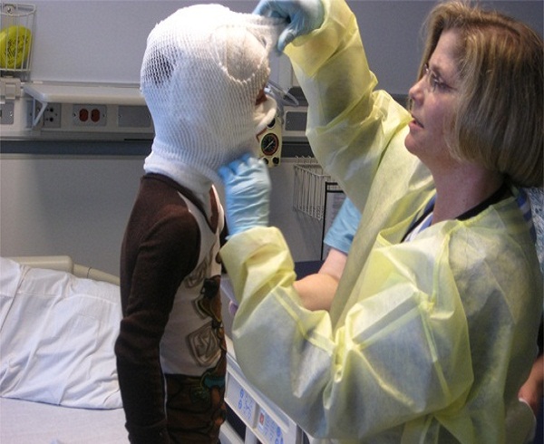 Descubren primer caso de viruela del mono en un niño de Argentina